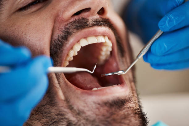 Best Emergency Wisdom Tooth Extraction in Bing, OR